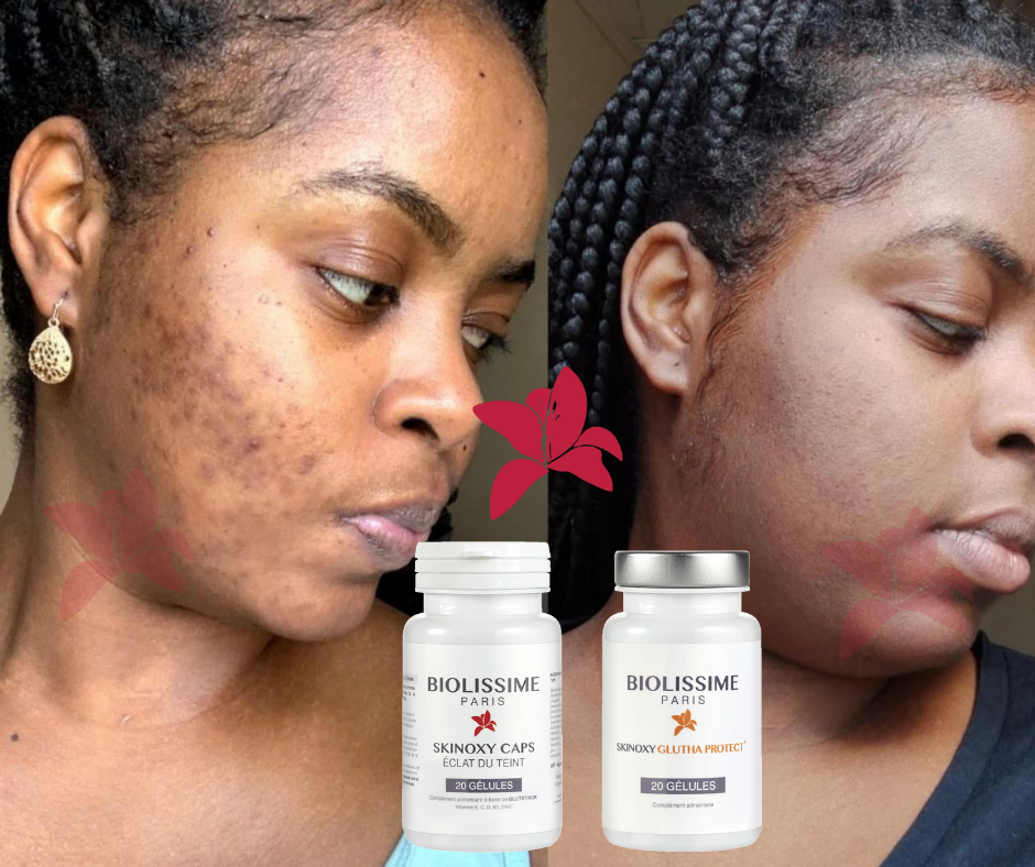 Précommande Pack Transformation SKYNOXY DUO – 3 Mois