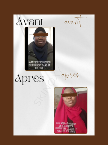 Pack Transformation  Anti-Taches, Mélasma & Anti-Âge Skinoxy – 3 Mois